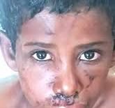 القبض على أب يعذب طفلته بالحرق في لحج