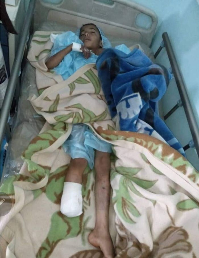 انفجار لغم حوثي يتسبب في بتر قدم طفل بمحافظة البيضاء