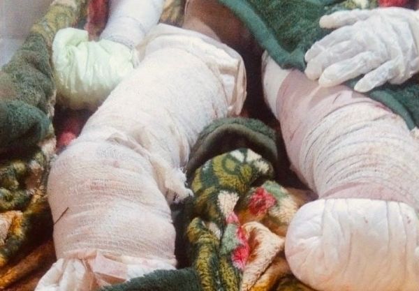 لغم حوثي يتسبب ببتر قدمي ويد طفل بحجة