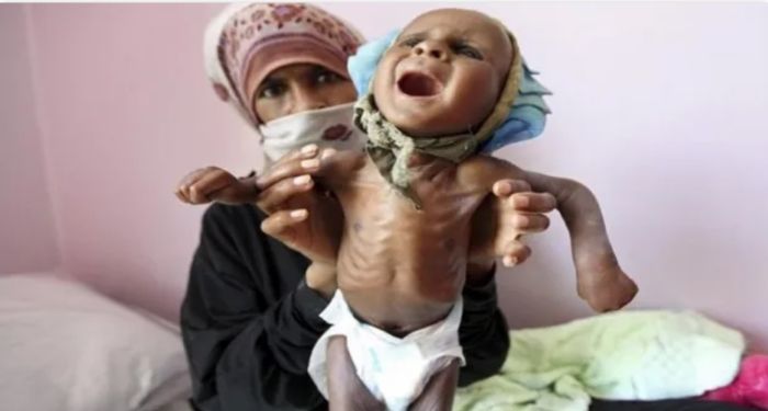 الأمم المتحدة:  8 ملايين امرأة وطفل مهددون بالموت بسبب سوء التغذية في اليمن
