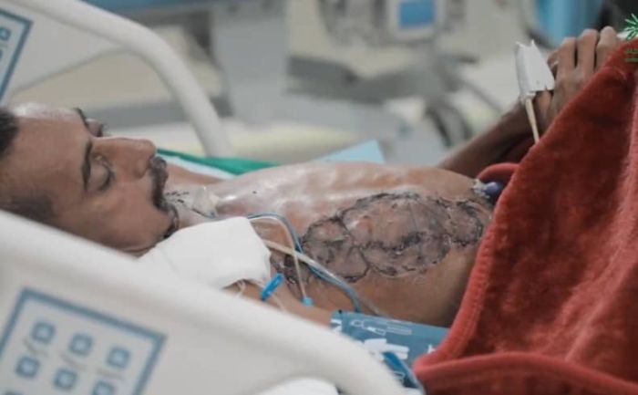 صور مؤلمة بصنعاء لضحايا المبيدات المسرطنة التي استوردتها قيادات حوثية من إسرائيل