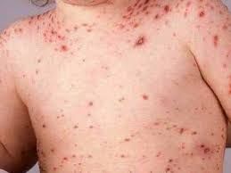 بسبب منع عصابة الحوثي للقاحات ..  ارتفاع ملحوظ في عدد الحالات المصابة بمرض الحصبة باليمن