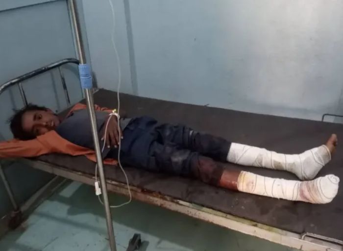  إصابة طفل بلغم حوثي في الحديدة