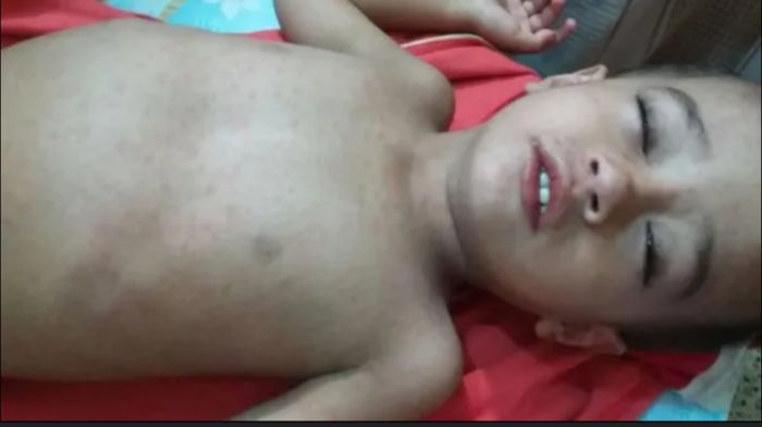 انتشار مخيف لمرض الحصبة في الضالع 