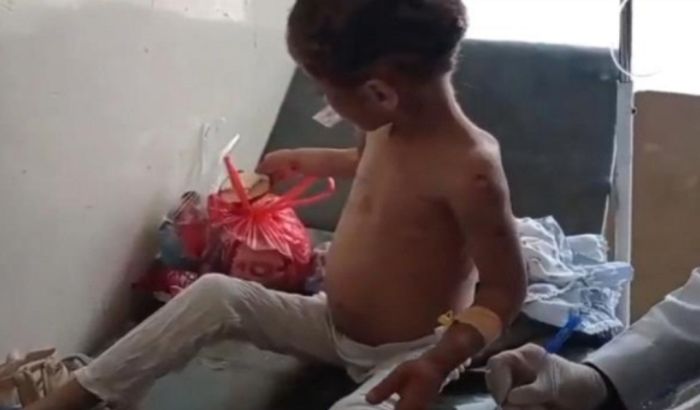  إب .. طفلة تتعرض لتعذيب وحشي على يد زوجة أبيها أفقدها الوعي