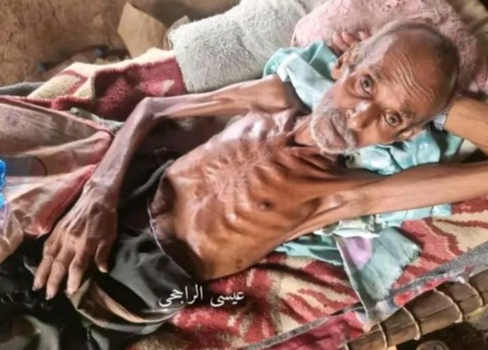  وفاة مسن جوعًا في مخيم للنازحين بمحافظة حجة