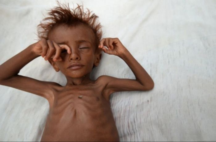  الأمم المتحدة تحذر من الجوع الجماعي في اليمن