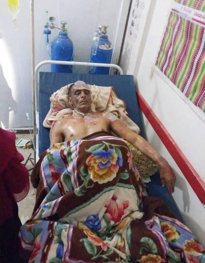  تعز.. امرأة تحرق زوجها بعد علمها بزواجه من امرأة أخرى