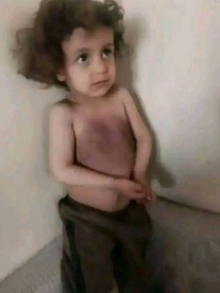 مصرع طفل تعذيبًا على يد إخوته في يريم