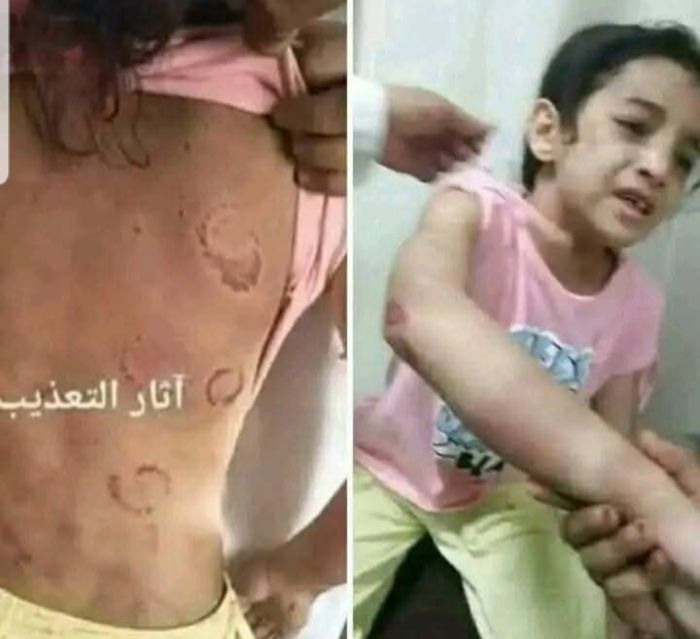  زوجة أب تُعذّب طفلة وتكسر أضلاعها لأنها لم تنظّف مطبخ المنزل