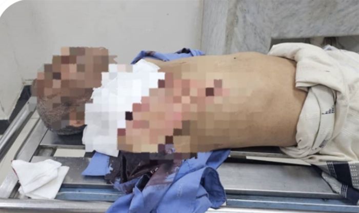  إصابة مواطن برصاص قناص حوثي في تعز