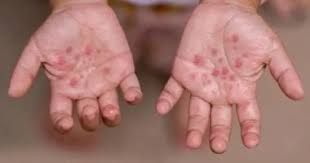 انتشار أمراض جلدية بين طلاب مدارس أهلية في مدينة التربة