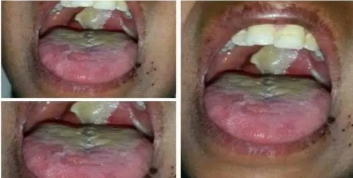 تسجيل 4 حالات وفاة بمرض الدفتيريا في مأرب