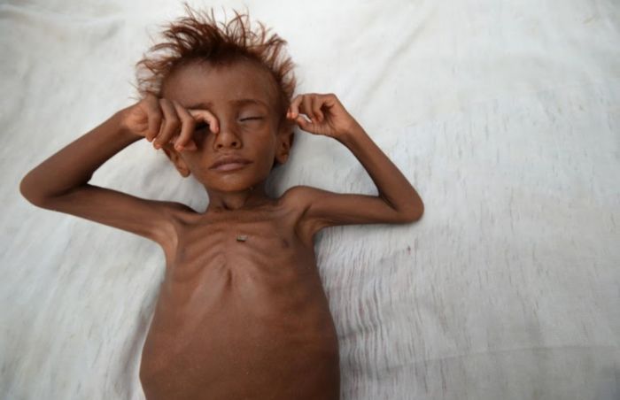  تقرير أممي: الجوع وأزمات الغذاء في اليمن والعالم العربي عند أعلى مستوياتها منذ 20 عامًا