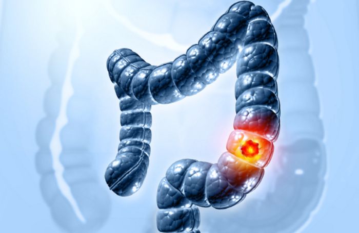 عامل خفي يزيد من خطر سرطان القولون