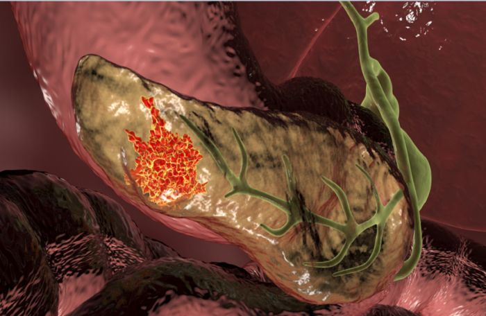 تجربة دوائية رائدة تحقق "اختفاء دائما" لسرطان البنكرياس