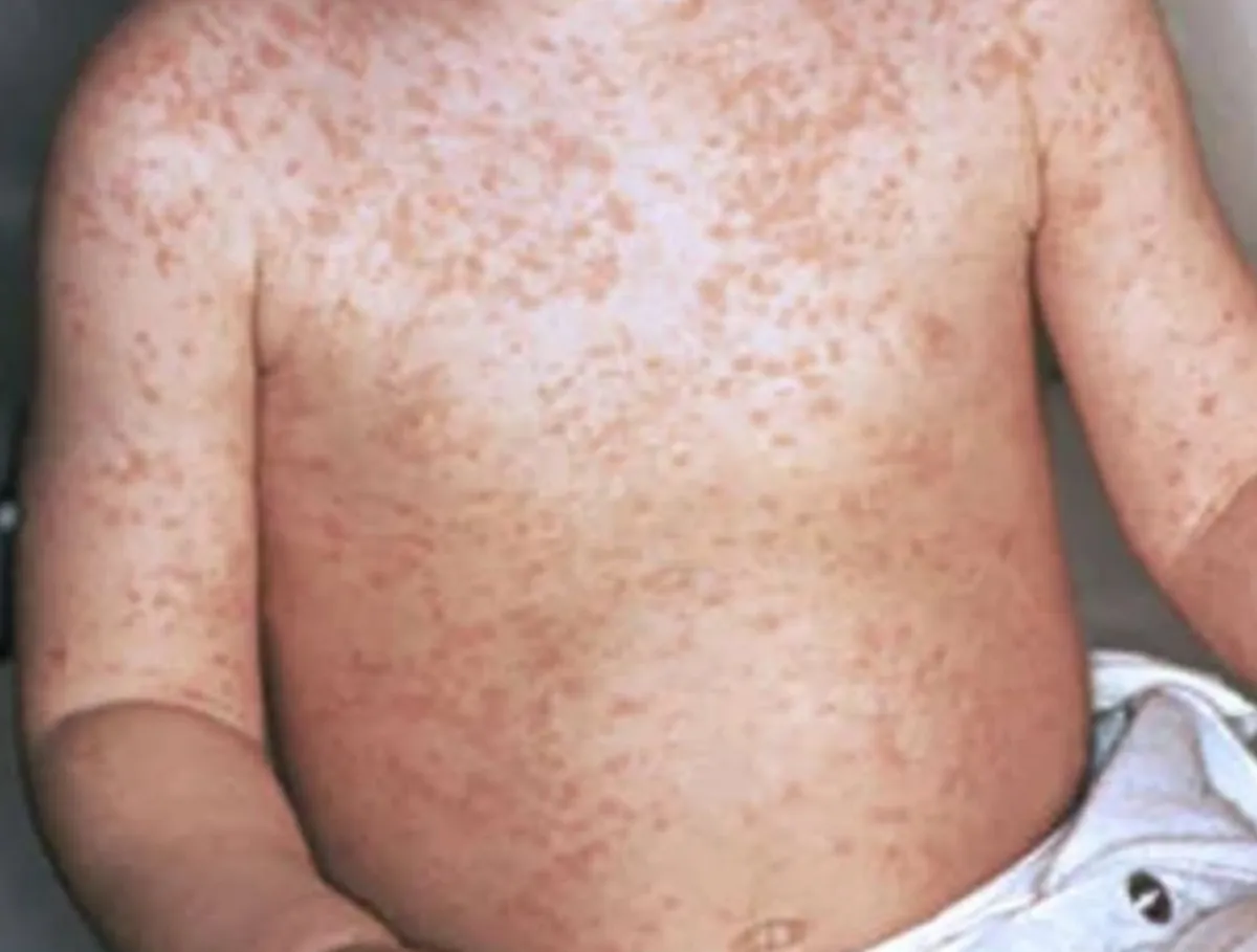 تسجيل أكثر من ألف إصابة بالحصبة و8 وفيات في مناطق الحكومة خلال شهر