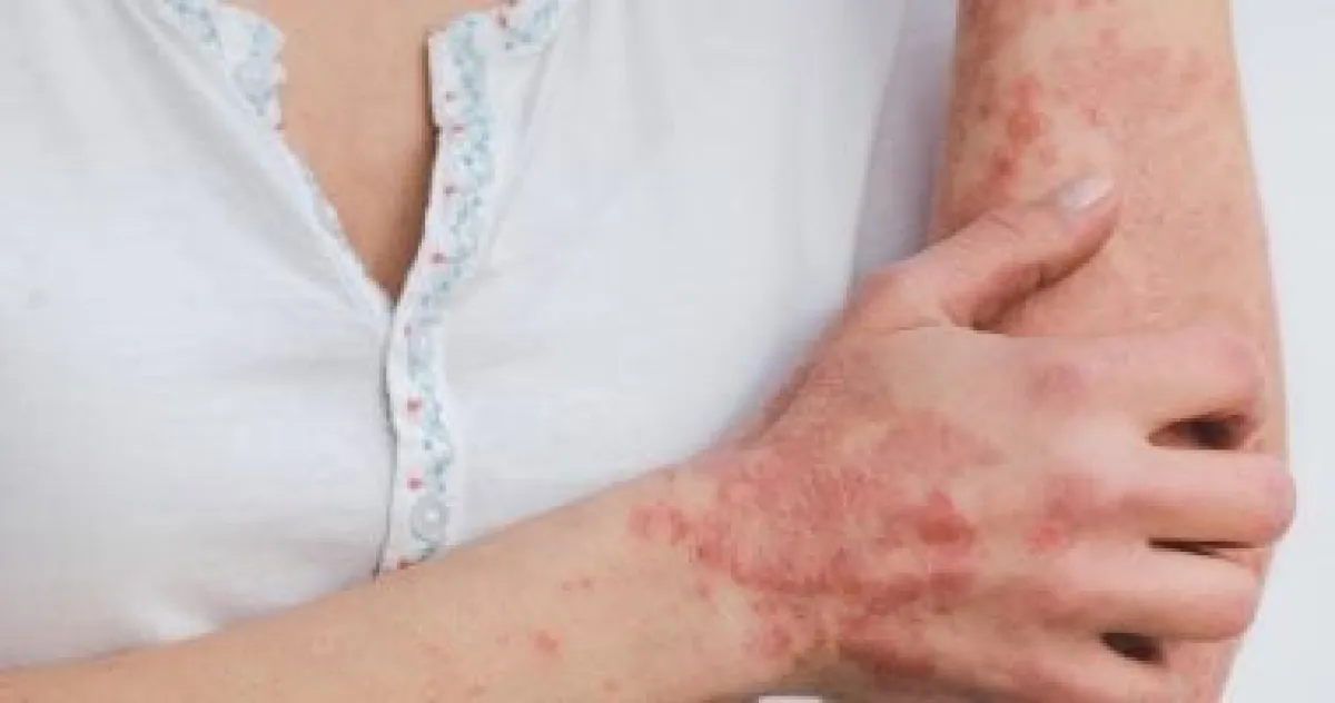 7 أطعمة أساسية لتهدئة أعراض الصدفية ودعم صحة الجلد