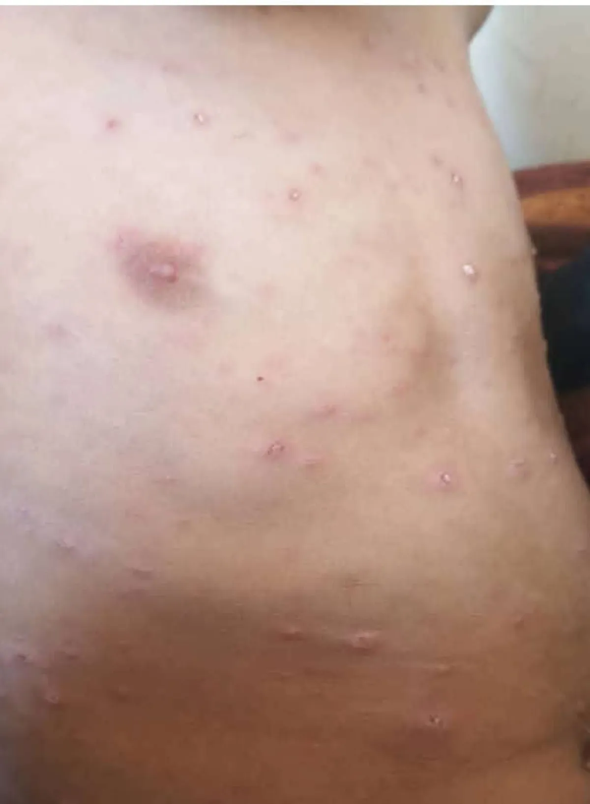 صنعاء تحت الحصار الصحي: جدري الماء وشلل الأطفال يهددان حياة الأطفال