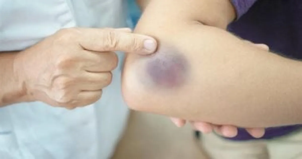 6 علاجات منزلية فعالة لتسريع شفاء الكدمات والتخلص من التورم