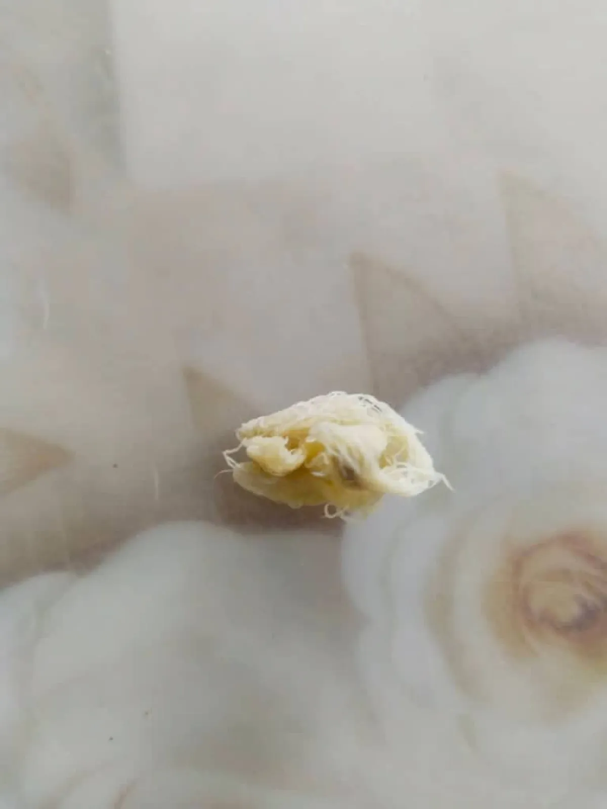 خطأ طبي مروع: قطعة قطنية تُترك في أنف شاب لعامين في لحج