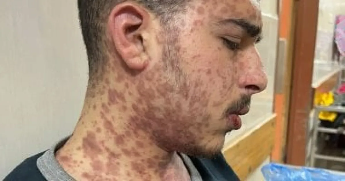 شاب فلسطيني يصارع الموت في غزة بسبب متلازمة ستيفن جونسون النادرة ونقص العلاج