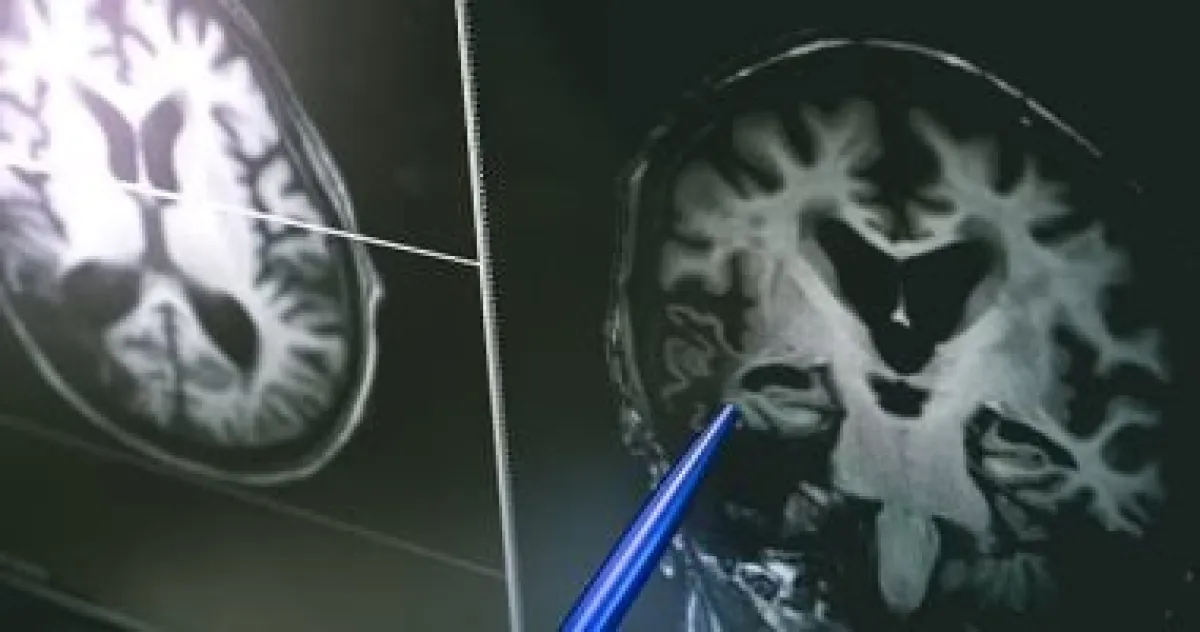 بؤر الدماغ: ما هي التلف الموضعي وكيف يتم تشخيصه وعلاجه؟