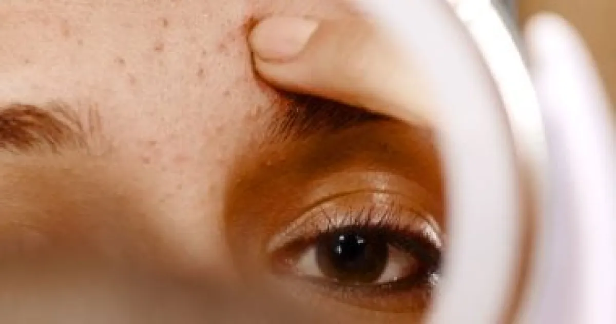 متى تصبح الحبوب أكثر من مجرد حب شباب؟ دليلك للعلامات التحذيرية