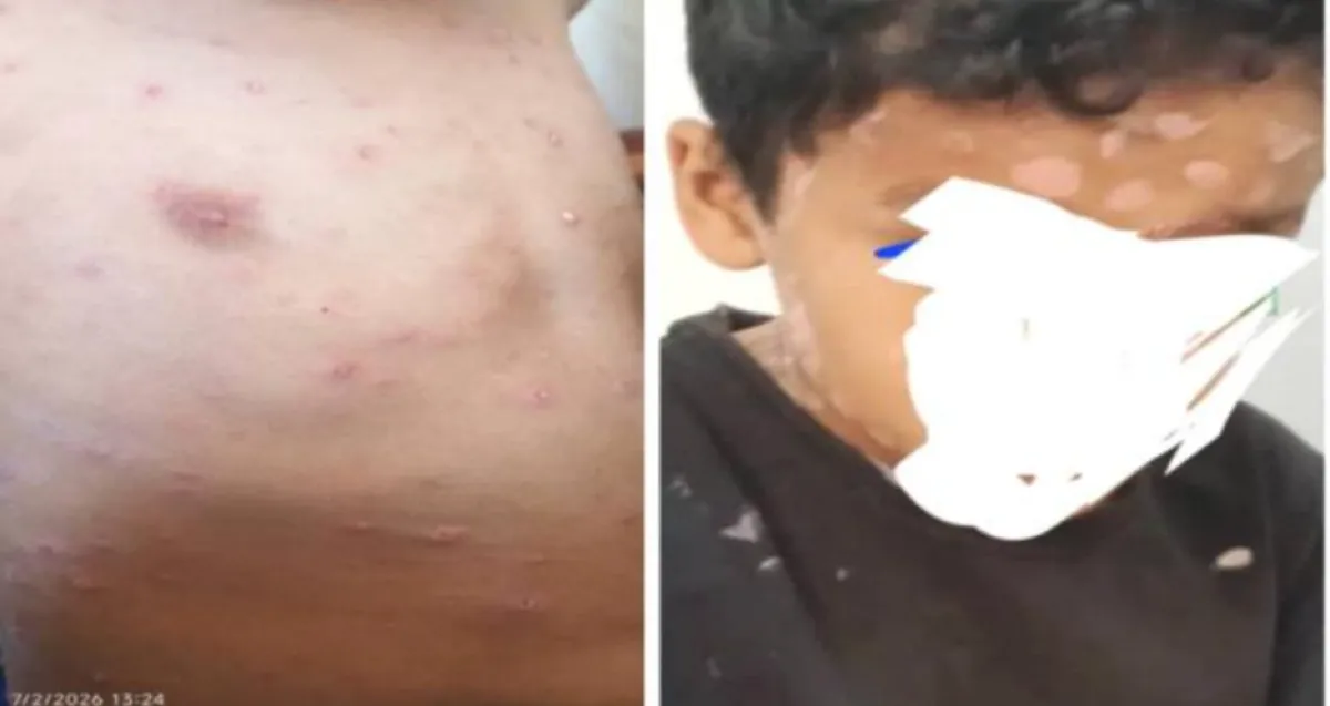 الحديدة .. تزايد حالات الإصابة بفيروس الجدري المائي وسط تجاهل صحة الحوثي