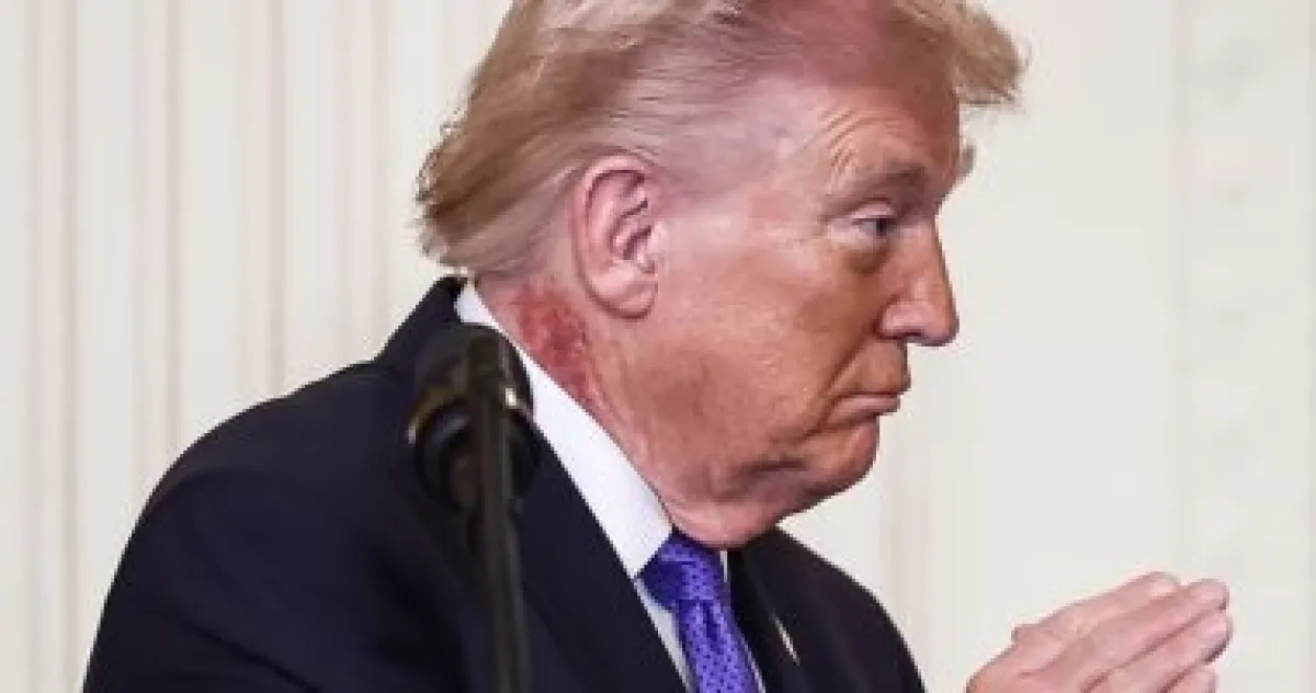 جلد ترامب يثير الجدل: طبيب يكشف سر الطفح الجلدي المؤقت