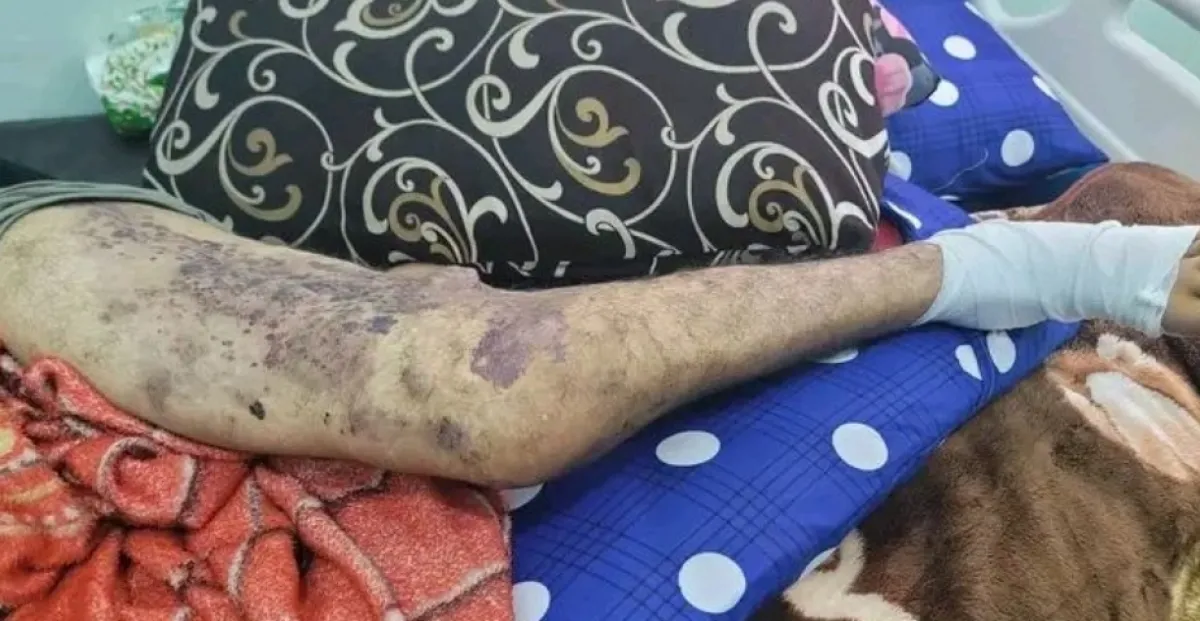 سجين في تعز يصارع الموت بمرض نادر وعجز عن دفع الدية