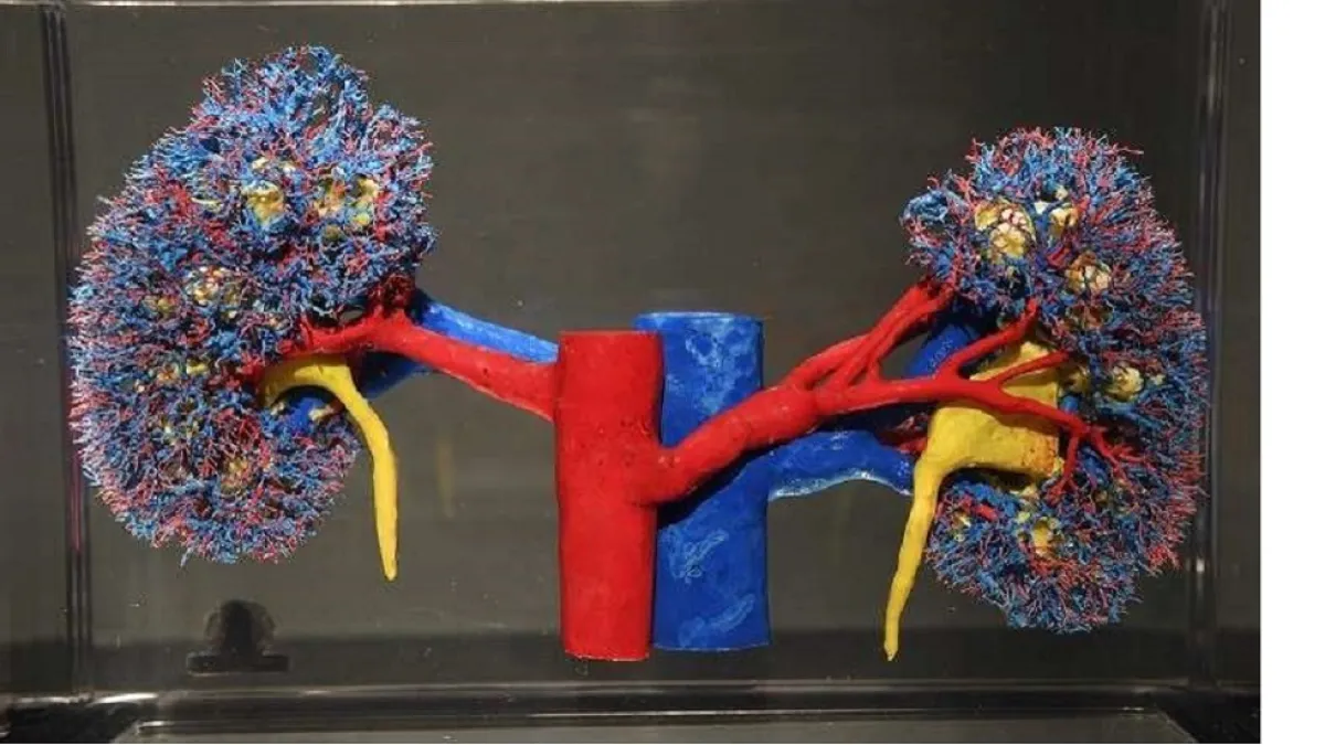 دليلك الصحي: أطعمة قد تزيد خطر حصوات الكلى وكيفية الوقاية