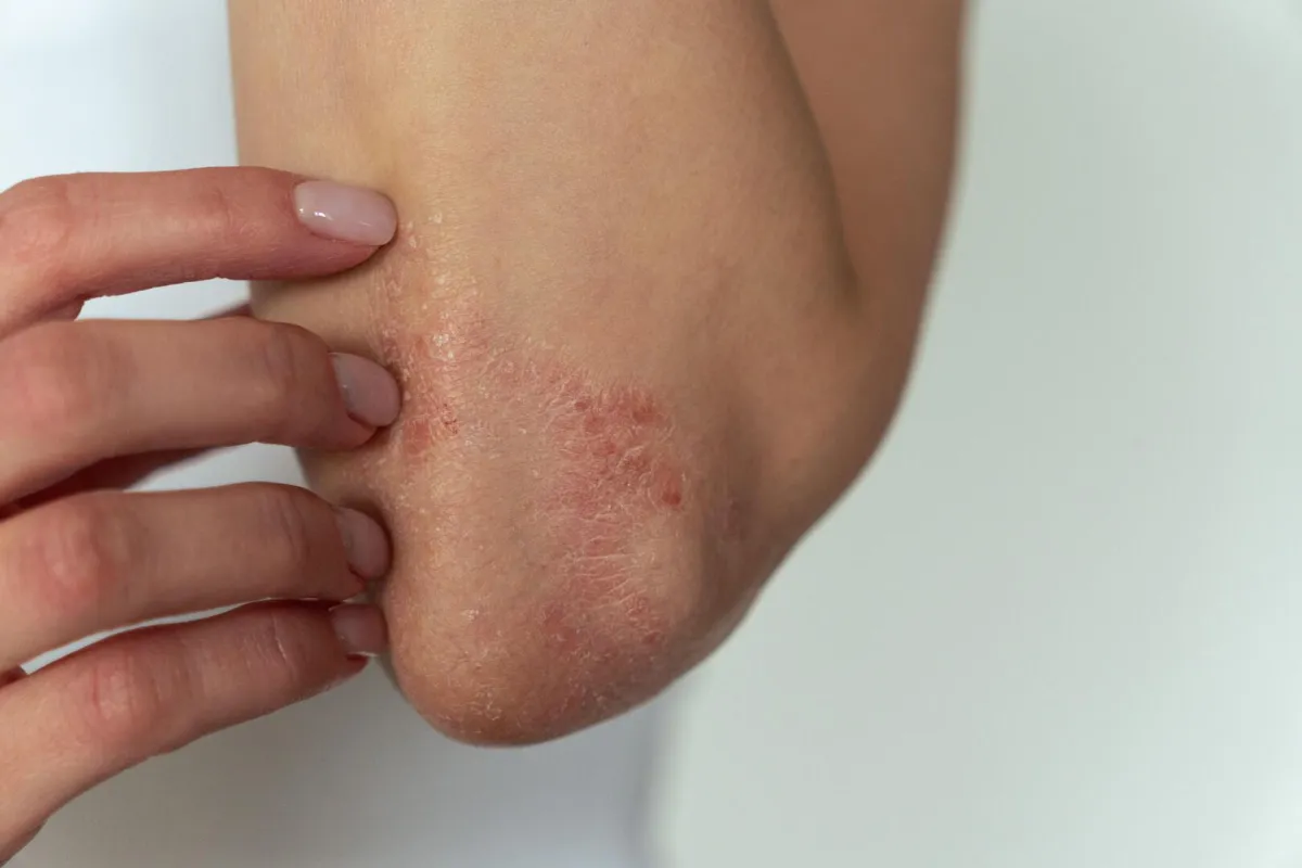 التهاب الجلد التأتبي: ما وراء الحكة.. اضطرابات النوم والذاكرة