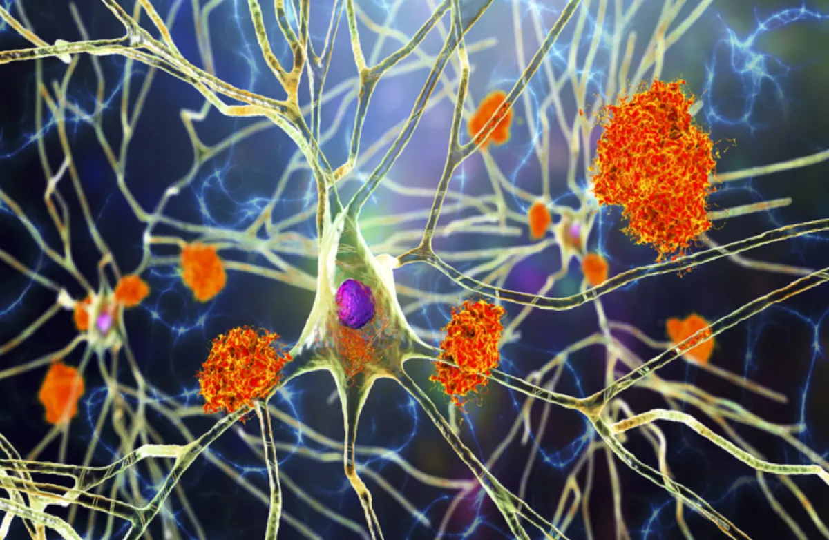 اكتشاف جديد: نقص الدوبامين يسرّع تدهور الذاكرة لدى مرضى ألزهايمر