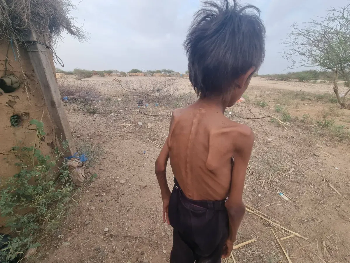 نداء استغاثة من حجة: أطباء بلا حدود تكشف عن تفاقم سوء تغذية الأطفال
