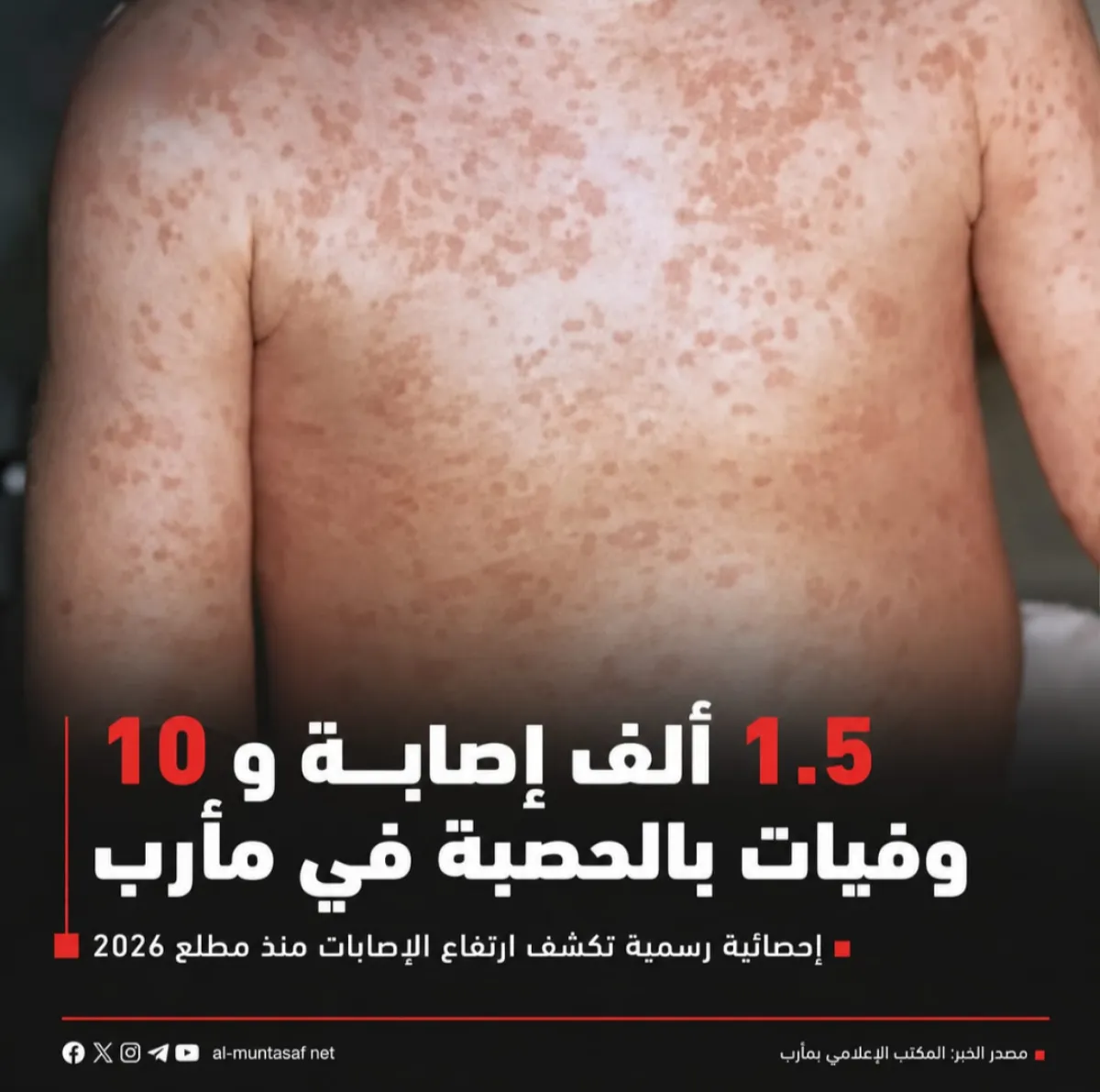 رسميًا.. تسجيل 1.5 ألف إصابة و10 وفيات بالحصبة في مأرب منذ مطلع 2026