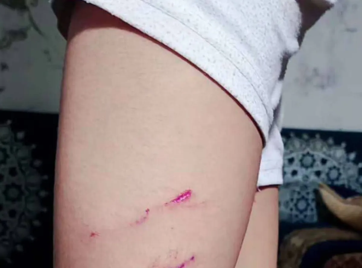 كلاب ضالة تهاجم طفلًا في تعز، والنقطة الرابع تطالب بـ35 ألفًا مقابل صرف حقنة مجانية