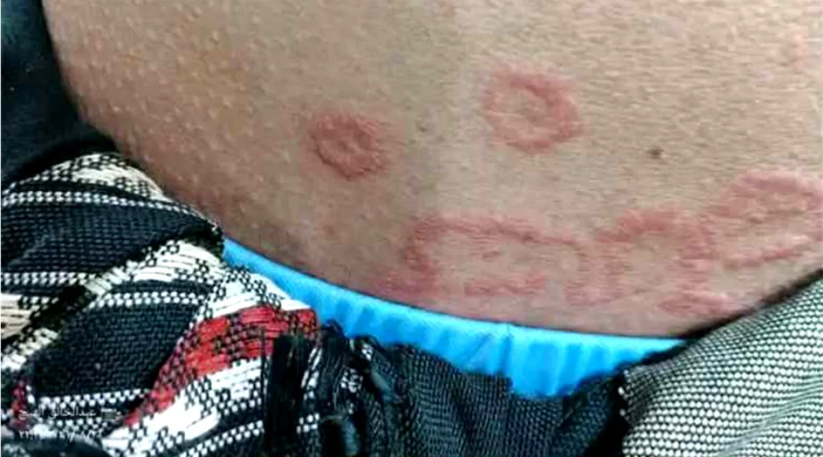 مرض جلدي يتفشى في الزهرة بالحديدة ومخاوف من توسع انتشاره