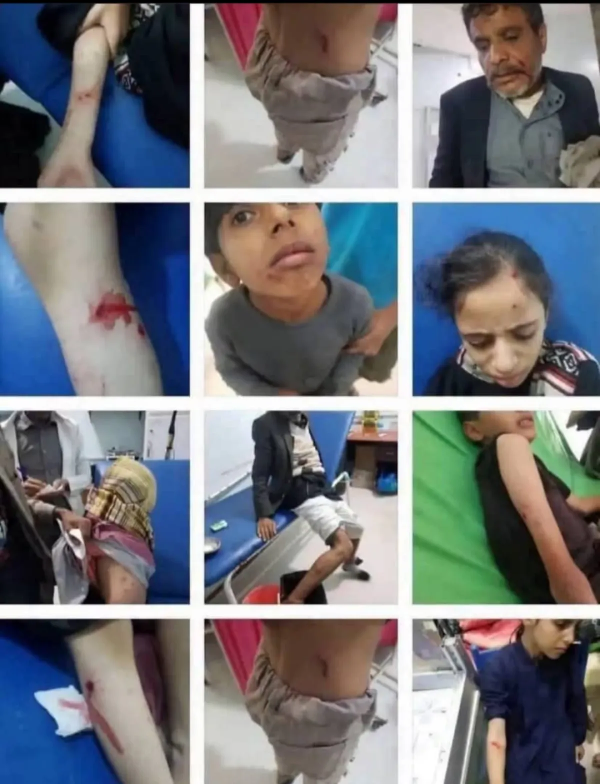 بسبب عبث مليشيا الحوثي بالقطاع الصحي .. إصابة 20 مواطناً بالكلاب المسعورة في المحويت